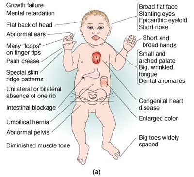 down syndrome effects
