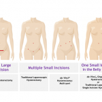 robotic surgery incision